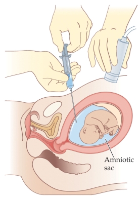 <strong>Refer to the figure. The figure illustrates _______, which is used to test for fetal abnormalities.</strong> A) quickening B) amniocentesis C) the Bradley method D) chorionic villus sampling E) cell-free fetal DNA analysis