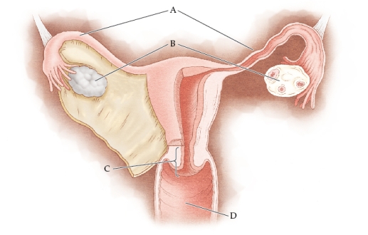 <strong>Refer to the figure The correct labels for the lettered structures are</strong> A) A: fimbria; B: ovaries; C: vagina; D: rectum B) A: oviducts; B: ovaries; C: cervix; D: vagina C) A: oviducts; B: fibroids; C: endometrium; D: perimetrium D) A: fimbria; B: fibroids; C: vagina; D: cervix E) A: endometrium; B: fimbria; C: cervix; D: rectum