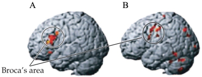 Refer to the image. The figure shows the pattern of brain activation during a language task. Which brain (A or B) shows abnormal activation? What could have caused this abnormality, and what would this do to language capacity in an individual?