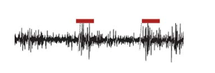 <strong> In the cortical EEG reading above, what would you expect the activity of a neuron simultaneously recorded in the locus coeruleus to be at the areas indicated by the red horizontal bar?</strong> A) a corresponding decrease in locus coeruleus firing B) a corresponding increase in locus coeruleus firing C) no change in locus coeruleus firing