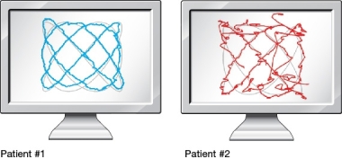 <strong>Refer to the figure below. The line on each screen reflects the eye movements of a patient tracking a moving cursor. Which of the following statements is most likely to be true?</strong> A) Patient 1 has schizophrenia but Patient 2 does not. B) Patient 2 has schizophrenia but Patient 1 does not. C) Patient 1 has a higher risk for schizophrenia than Patient 2. D) Patient 2 has a higher risk for schizophrenia than Patient 1.