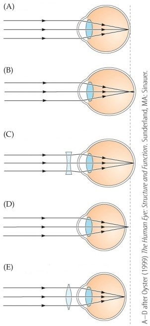 <strong>Refer to the figure. Which part of the figure depicts hyperopia without correction?</strong> A) A B) B C) C D) D E) E