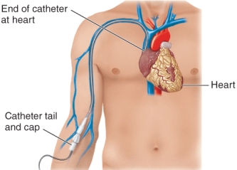 <strong>The medical device shown in the illustration is a </strong> A) CVC B) Urinary catheter C) Postoperative drain D) PICC line