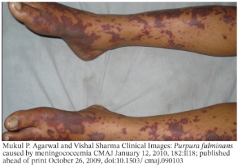<strong>The medical condition in the photo is </strong> A) Shock B) Disseminated intravascular coagulation C) Peripheral vein thrombosis D) Adult coagulation syndrome