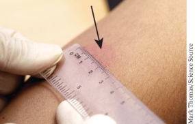 <strong>The indicated skin lesion denoting a positive Mantoux Test result is known as a(n) ______________. </strong> A) bulla B) hive C) induration D) papule