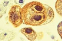 <strong>This micrograph of virally-infected cells demonstrates the cytopathic effect known as ________. </strong> A) nucleomegaly B) inclusion bodies C) syncytium formation D) cellular rounding