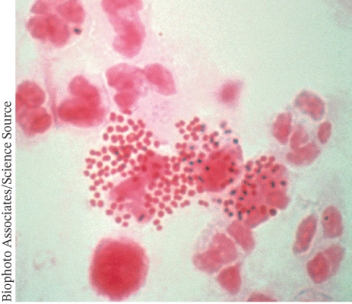 <strong>A 20-year-old male presented at the emergency room with intense burning during urination. A copious amount of pus was being discharged from his penis. A micrograph of a gram stain of the pus is shown below. The man is infected with ________. </strong> A) gram negative bacteria that have infected leukocytes B) gram positive bacteria that have infected leukocytes C) gram positive bacteria and gram positive eukaryotic pathogens D) gram negative bacteria and gram negative eukaryotic pathogens