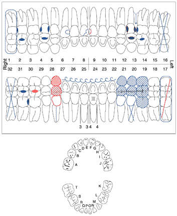 <strong> Using the chart above, what is charted on Tooth #28?</strong> A) abscessed and a porcelain fused to a metal crown B) Missing C) Completed root canal and a porcelain fused to a metal crown D) None of the above