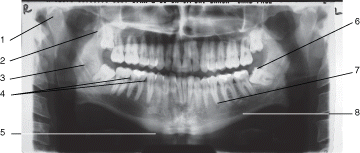 Utilizing the panoramic radiograph, identify the following mandibular landmarks by abbreviations. A. (ac) B. (bom) C. (c) D. (cor) E. (eor) F. (mc) G. (mf) H. (s)