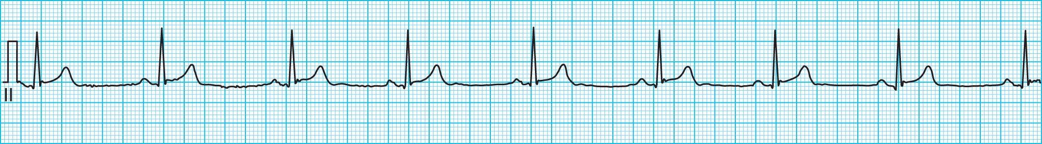 <strong>Stress, exercise, general health, previous cardiac events, even sleeping can all alter the heart rate. What type of heart rate does the ECG tracing in the figure below represent? </strong> A) A-Fib B) Bradycardia C) Tachycardia D) Normal heart rate
