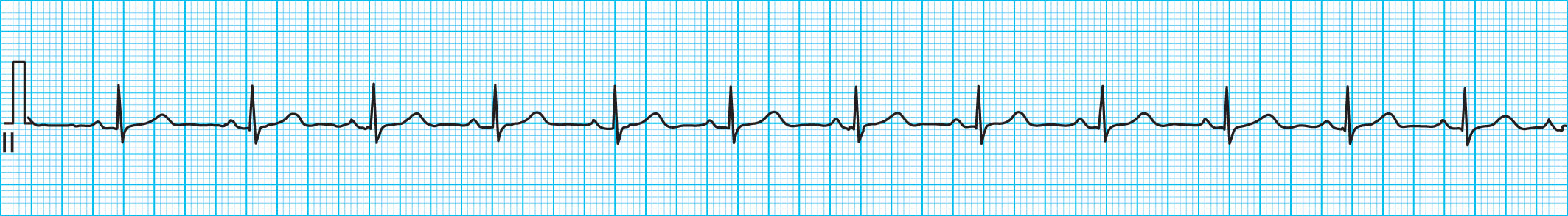<strong>Which of the following heart rhythms, as shown in the figure below, must have all the normal rhythm values plus the P wave must be upright and uniform in Lead II and the rhythm must be consistent with very little deviation? </strong> A) Normal sinus B) Regularly irregular C) Occasionally irregular D) Irregularly irregular