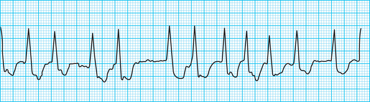 <strong>With an irregularly irregular rhythm there is no R-R pattern or similarity between the P-R interval or QRS complexes. Irregularly irregular rhythms are due to abnormalities found in the atria. What disorder that has an irregularly irregular rhythm is illustrated in the ECG tracing in the figure below? </strong> A) Wandering atrial pacemaker B) Atrial tachycardia C) Atrial fibrillation D) Atrial depolarization