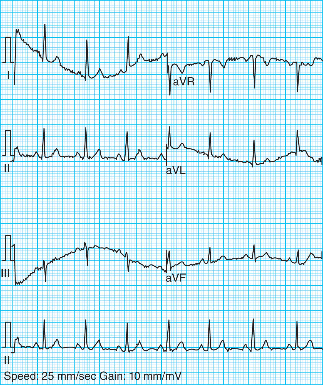 <strong>Which of the following movement errors does the ECG tracing below show? </strong> A) Somatic tremor B) Wandering baseline C) Shivering D) Parkinson's disease