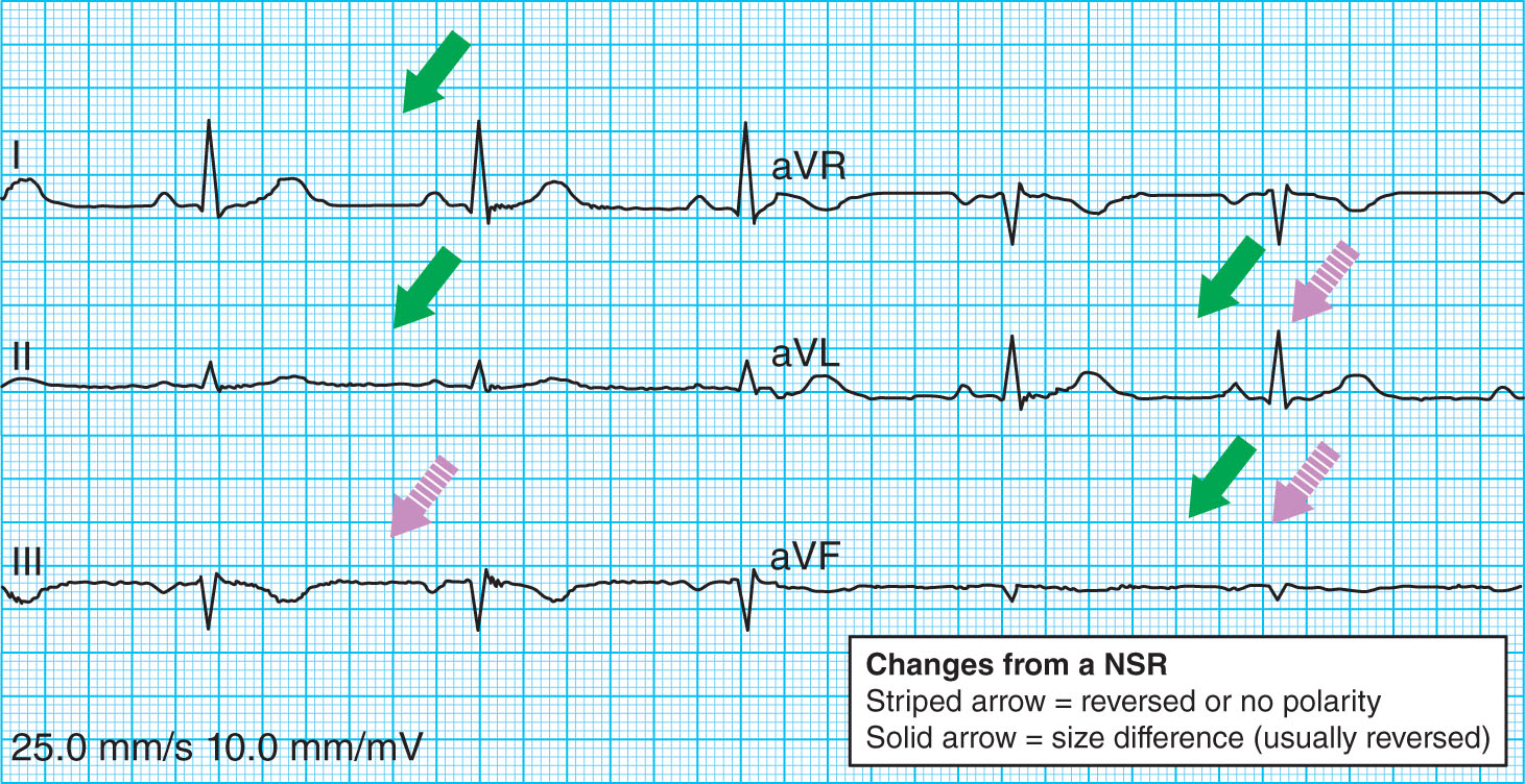 <strong>Which of the following limb lead reversal errors does this ECG tracing represent? </strong> A) Reversal of left arm and left leg leads B) Reversal of left arm and right arm leads C) Reversal of right arm and right leg leads D) Both arms and legs limb leads reversed