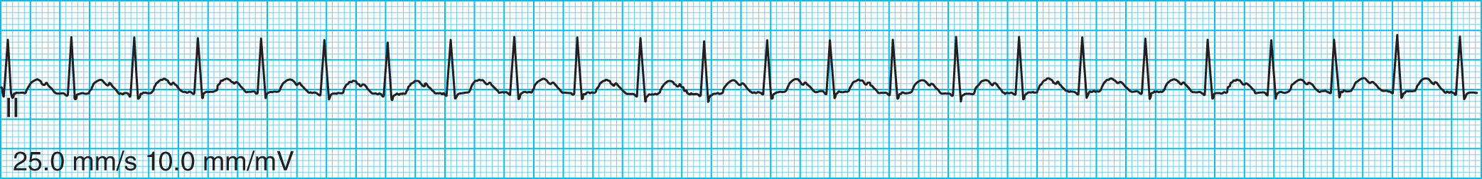 <strong>Calculate the heart rate for the ECG tracing below. </strong> A) 60 bpm B) 85 bpm C) 115 bpm D) 140 bpm