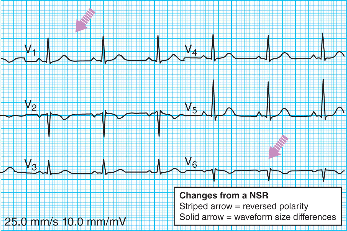 <strong>Which of the following precordial lead errors does this ECG tracing represent? </strong> A) Reversal of V1 and V6 B) Reversal of V1 and V2 C) Reversal of right arm and right leg leads D) Both arms and legs limb leads reversed