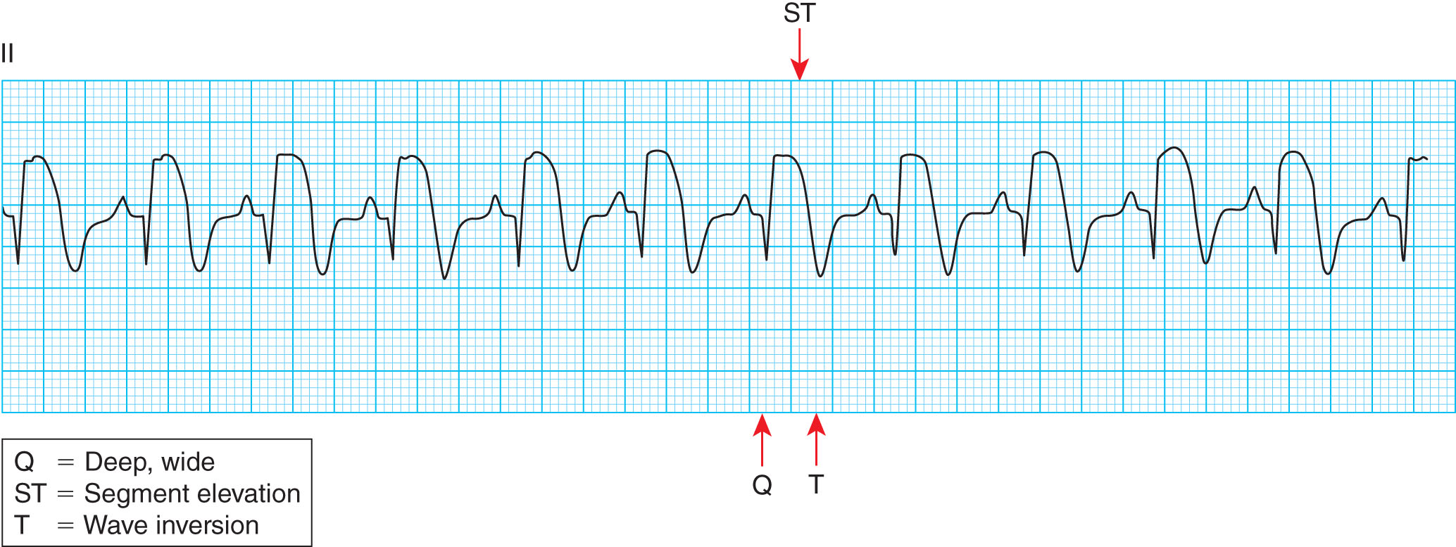 <strong>What heart condition does this tracing indicate is evolving? </strong> A) Junctional tachycardia B) Supraventricular arrhythmia C) Acute myocardial infarction D) Atrial tachycardia