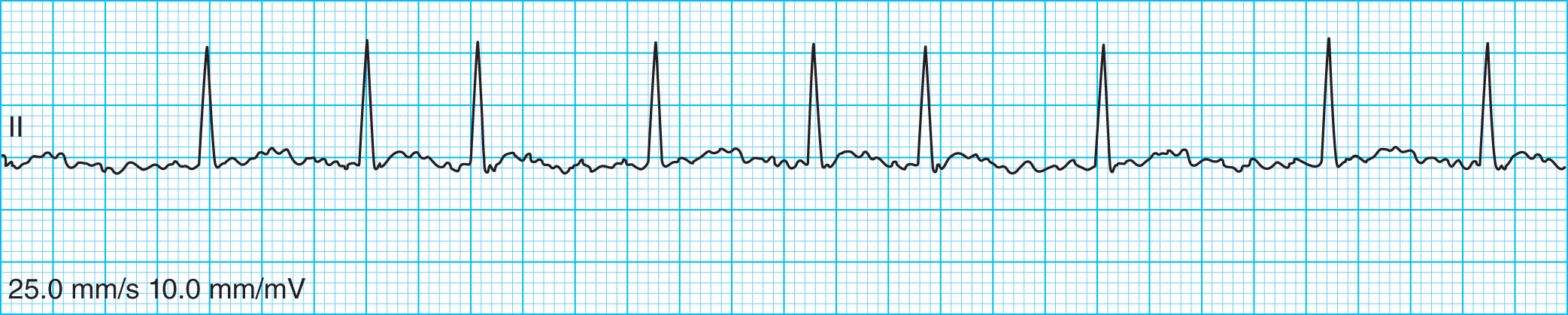 <strong>Classify the rhythm of the ECG tracing below. </strong> A) Atrial fibrillation B) Atrial flutter C) Normal sinus rhythm D) Premature atrial complex