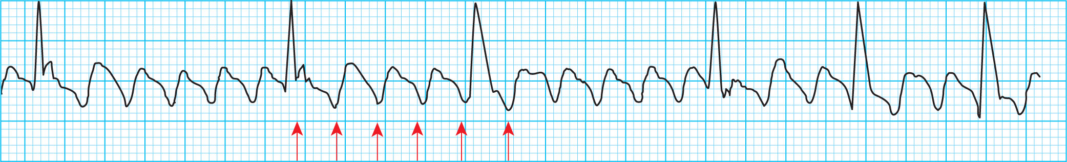 <strong>What heart condition do the waves in the ECG tracing below represent? </strong> A) Junctional arrhythmia B) Atrial flutter C) Atrial tachycardia D) Atrial fibrillation