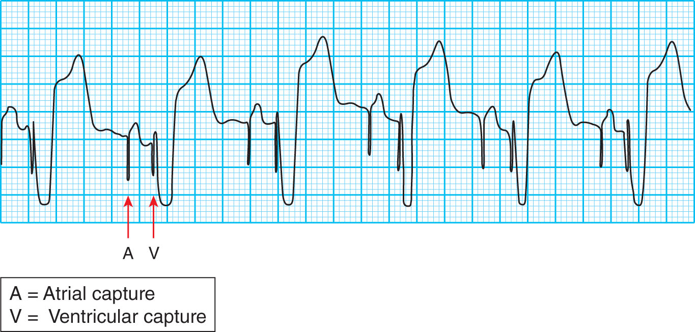 <strong>What type of pacemaker ECG reading does the tracing below represent? </strong> A) Loss of capture B) Atrial pacemaker rhythm C) Ventricular pacemaker rhythm D) Dual chamber pacemaker rhythm