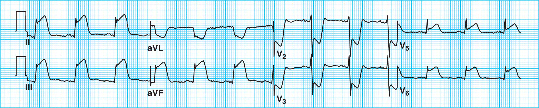 <strong>The ECG tracing below shows how an abnormal ST segment may appear with which of the following? </strong> A) Acute ischemia or injury in leads V1-V4 with an anterior wall injury B) The location of damage with an MI C) Acute ischemia or injury in Leads II, III, and aVF with an inferior wall injury D) An old inferior infarction