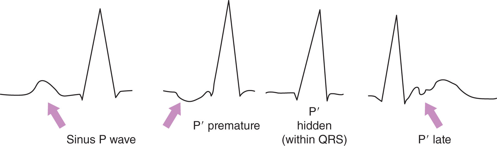 <strong>The ECG tracing below identifies the sinus P wave and possible P prime (P') wave presentations for what type of rhythm? </strong> A) Normal sinus rhythm B) Junctional tachycardia rhythm C) Junctional rhythm D) Accelerated junctional rhythm
