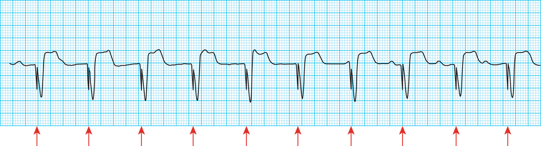 <strong>The ECG tracings in Figure 8-18 are very short vertical straight lines which can be as small as 2 ms. What do these tracings represent? </strong> A) Loss of capture B) Dual chamber pacing C) Atrial paced rhythm D) Pacemaker spikes