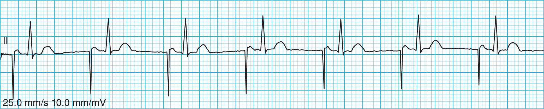<strong>What type of pacemaker rhythm is shown in the ECG tracing below? </strong> A) Loss of capture B) Dual chamber pacing rhythm C) Ventricular pacing rhythm D) Atrial pacing rhythm